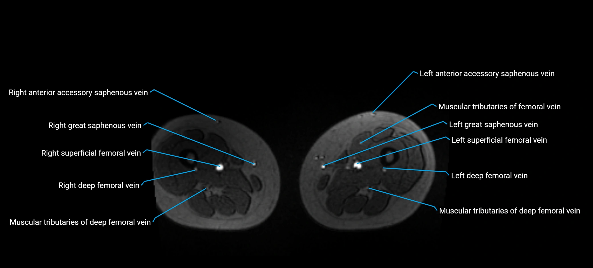 MRV abdomen pelvis & lower limb axial cross sectional anatomy labelled MRI image 284 (1).webp